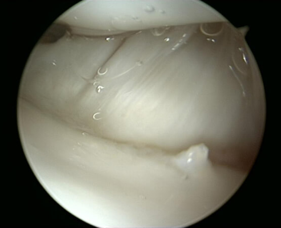 Eine Handgelenksspiegelung bzw. Arthroskopie ermöglicht eine exakte Diagnose bei Handgelenksproblemen.